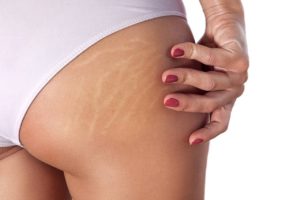 Éliminer la Cellulite Naturellement