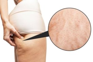 Démystifiez les causes de la cellulite et adoptez une approche informée pour une peau lisse et tonifiée.
