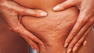 Solutions naturels contre la cellulite